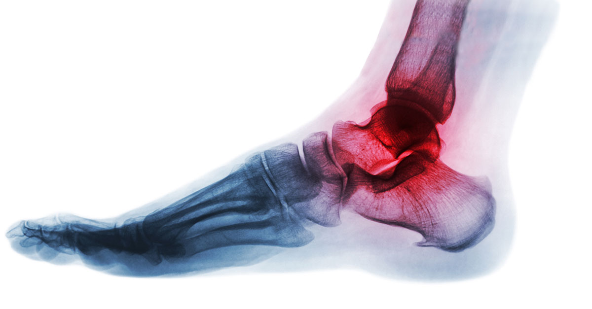 Best Treatments for Ankle Arthritis Bottom Line Inc