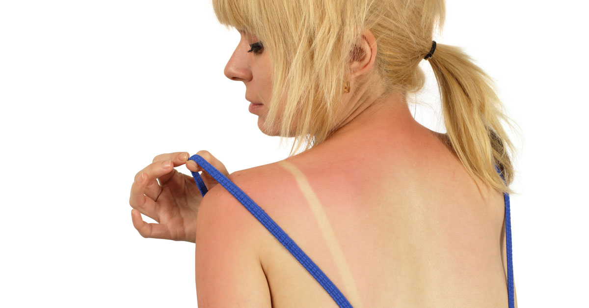 Drugs That Give You Sunburn Bottom Line Inc