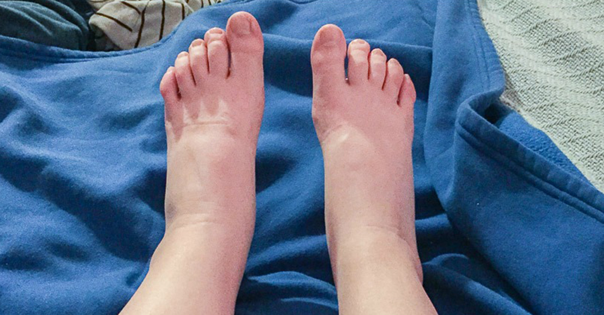 Remedies for Edema Swollen Feet, Swollen Ankles, Swollen Hands and the Rest of You Bottom